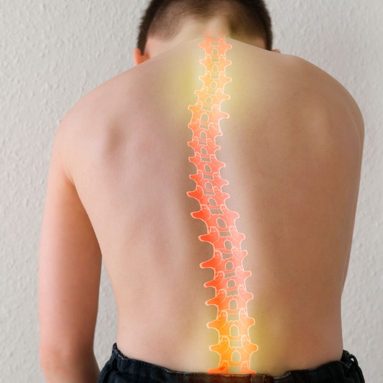 Escoliosis en niños y adolescentes