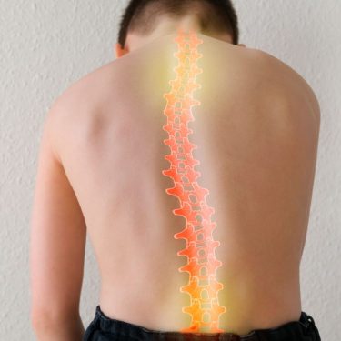 Escoliosis en niños y adolescentes